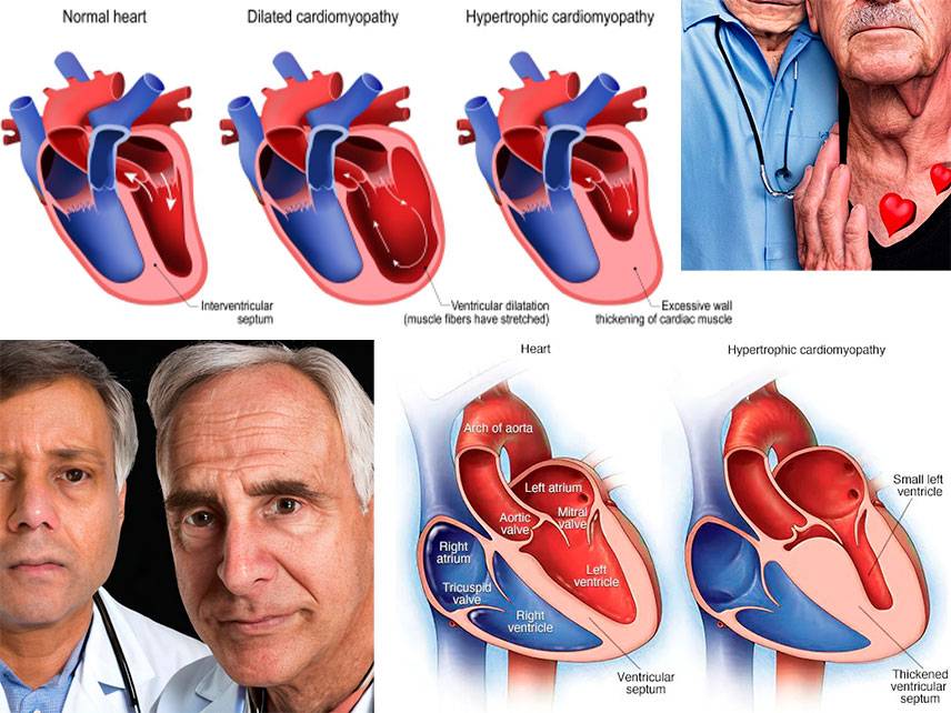 ¿Qué es la miocardiopatía: síntomas, diagnóstico, tratamiento?