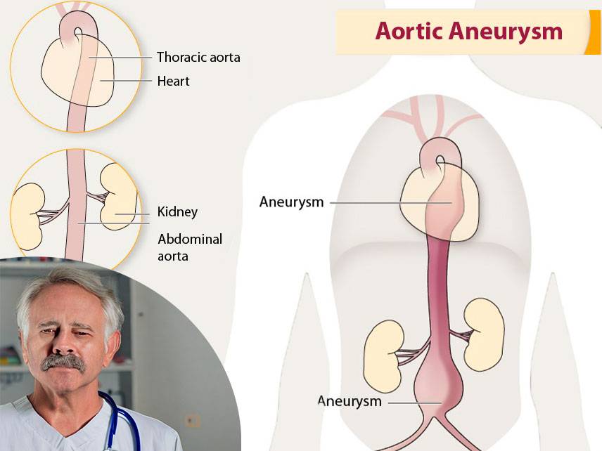 ¿Qué es un aneurisma aórtico: síntomas, diagnóstico, tratamiento?