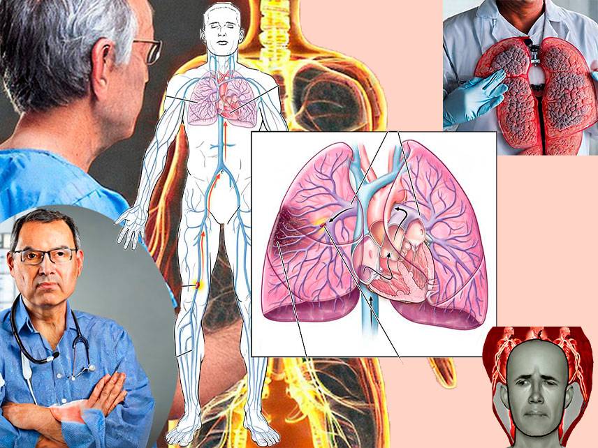 ¿Qué es una embolia pulmonar: síntomas, diagnóstico, tratamiento?