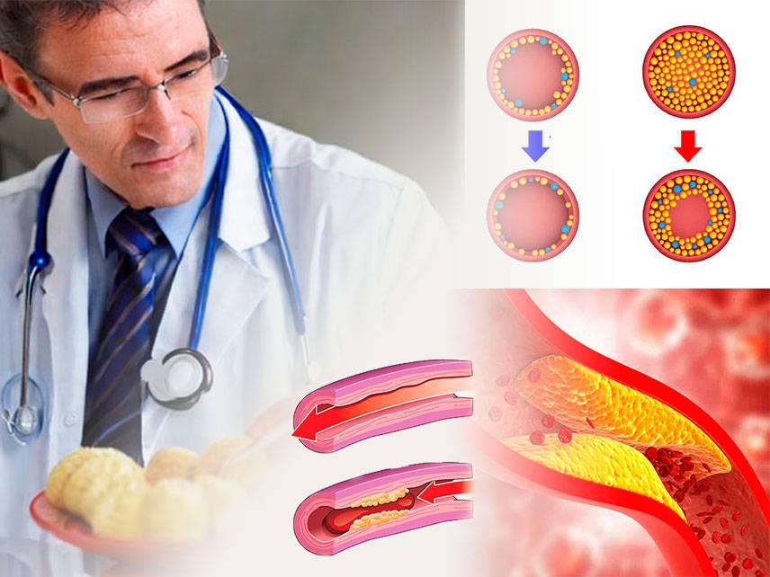 Colesterol alto: síntomas, diagnóstico, tratamiento.