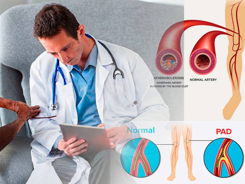 Arteriopatía periférica: síntomas, diagnóstico, tratamiento.