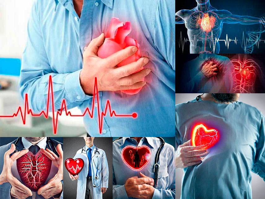 Infarto de miocardio (ataque al corazón): síntomas, diagnóstico, tratamiento